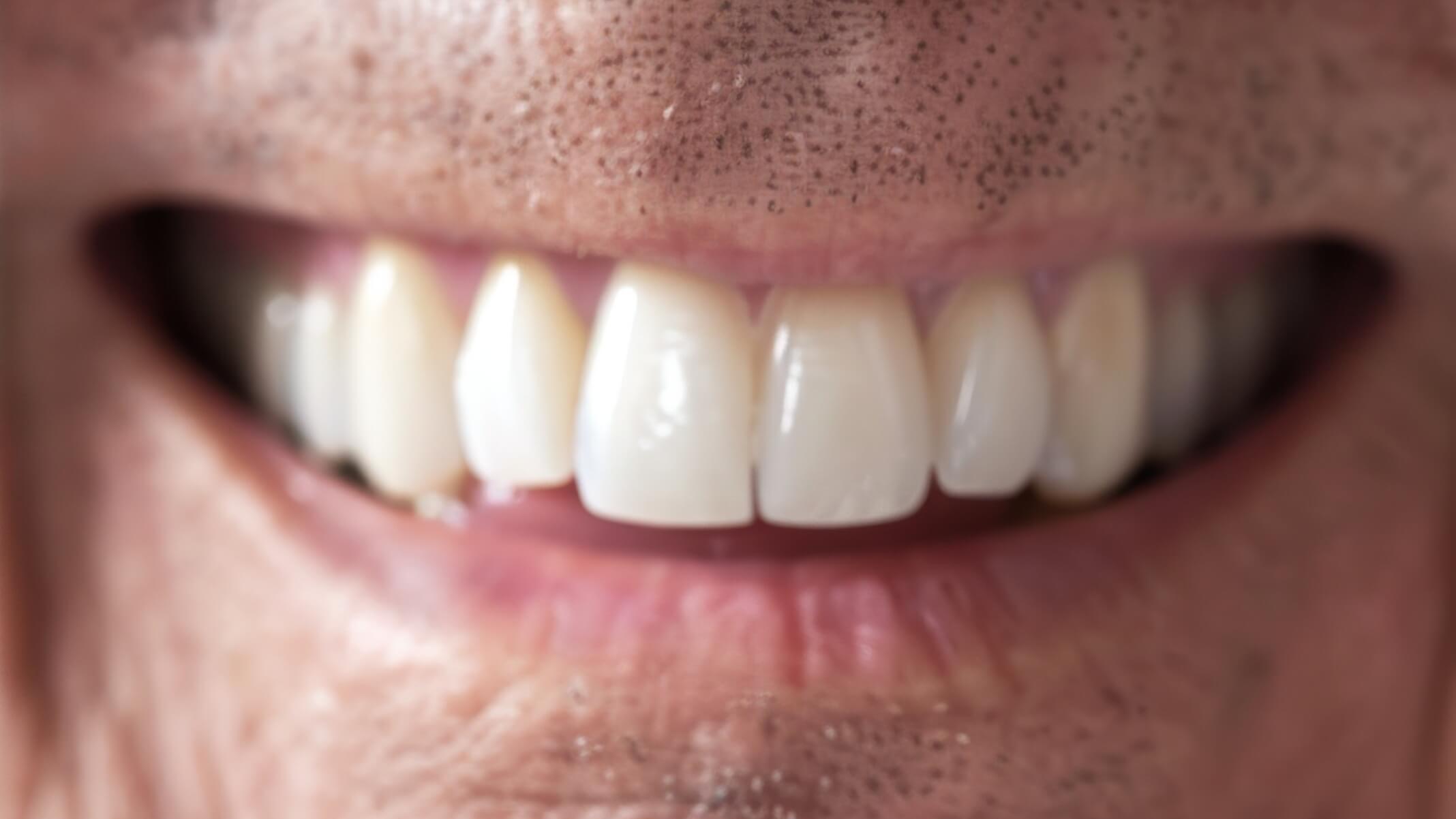 Estética dental después 2