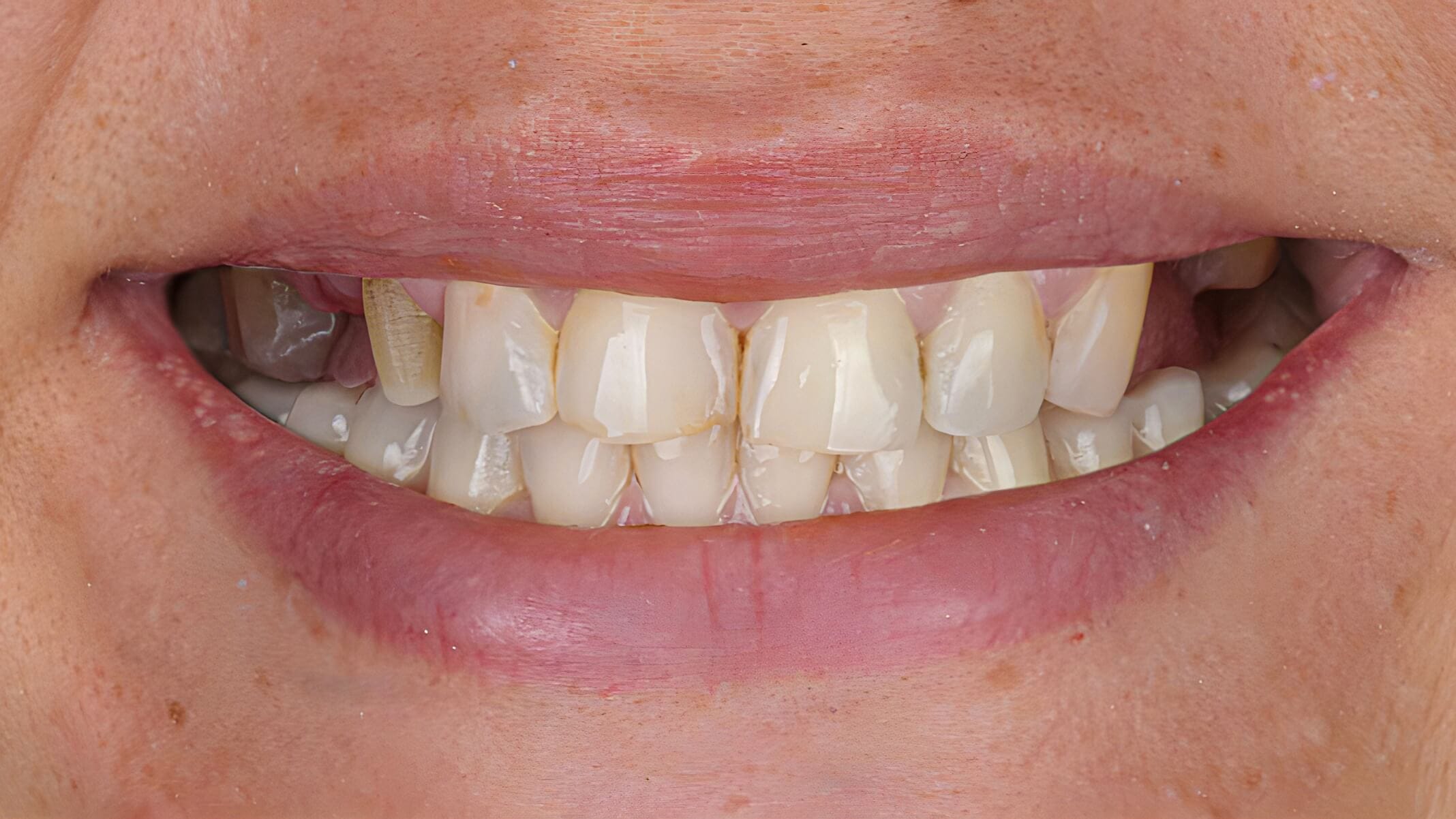 Estética dental antes 3