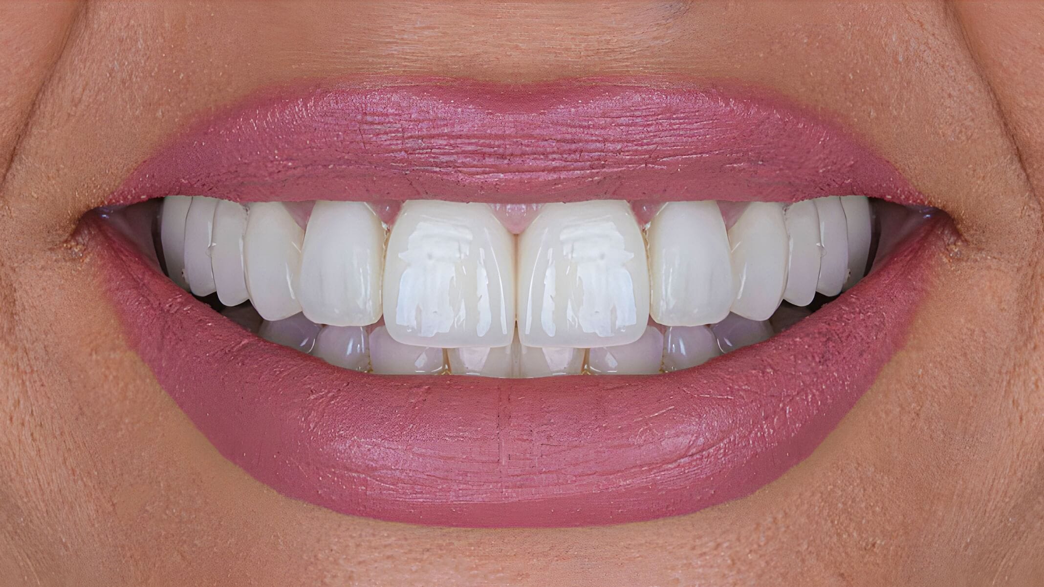 Estética dental después 1