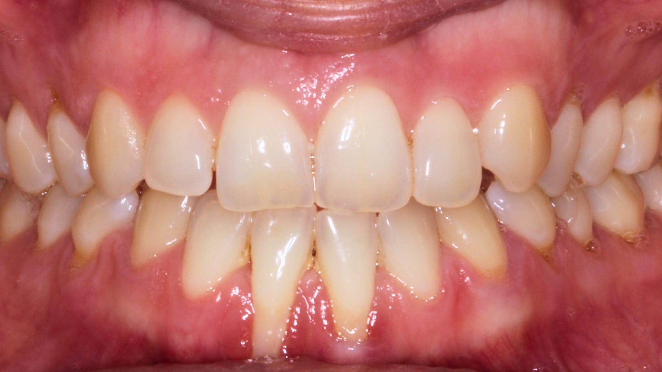 Periodoncia antes 2