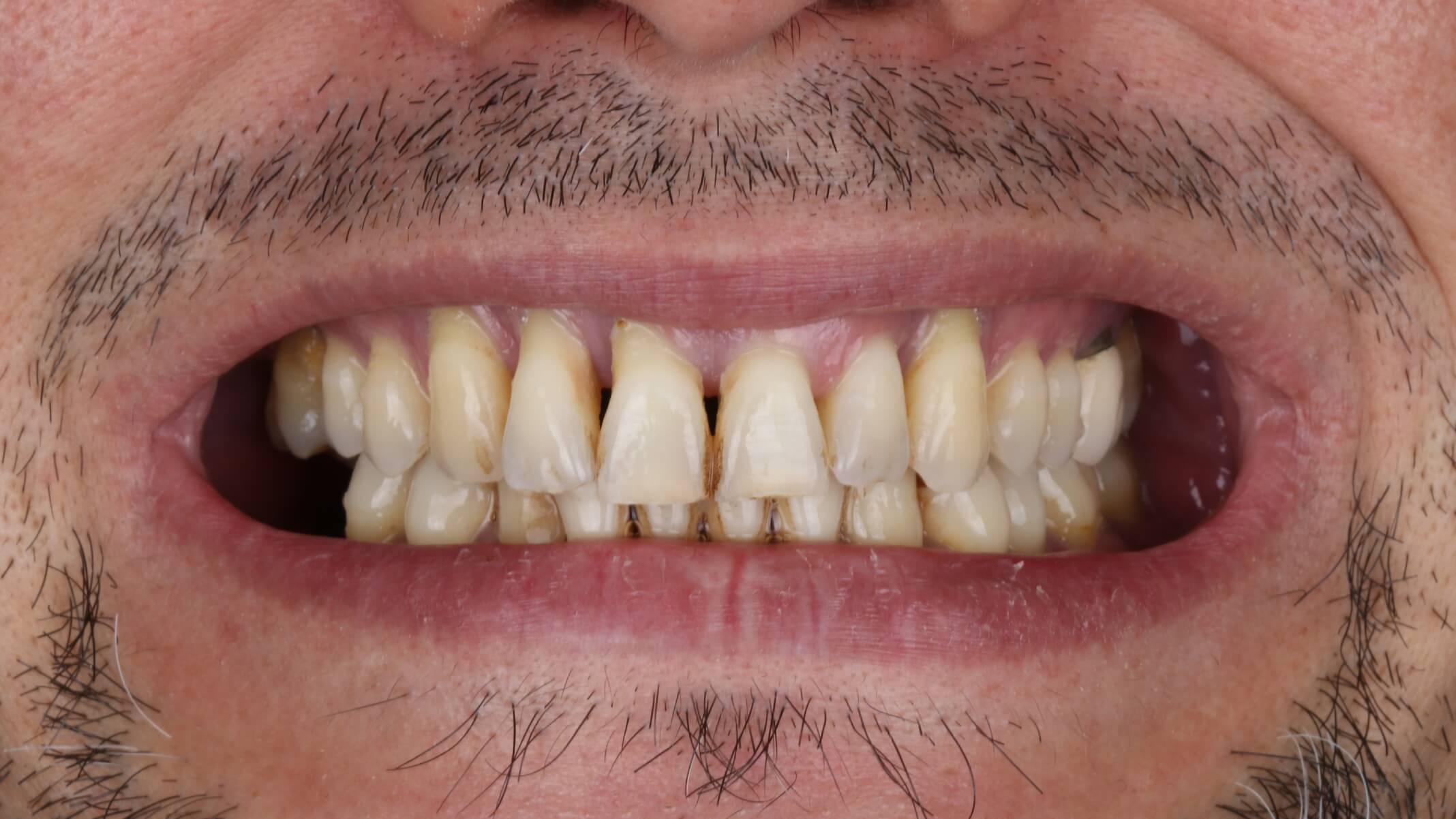 Implante dental antes 2 Implante dental antes 2