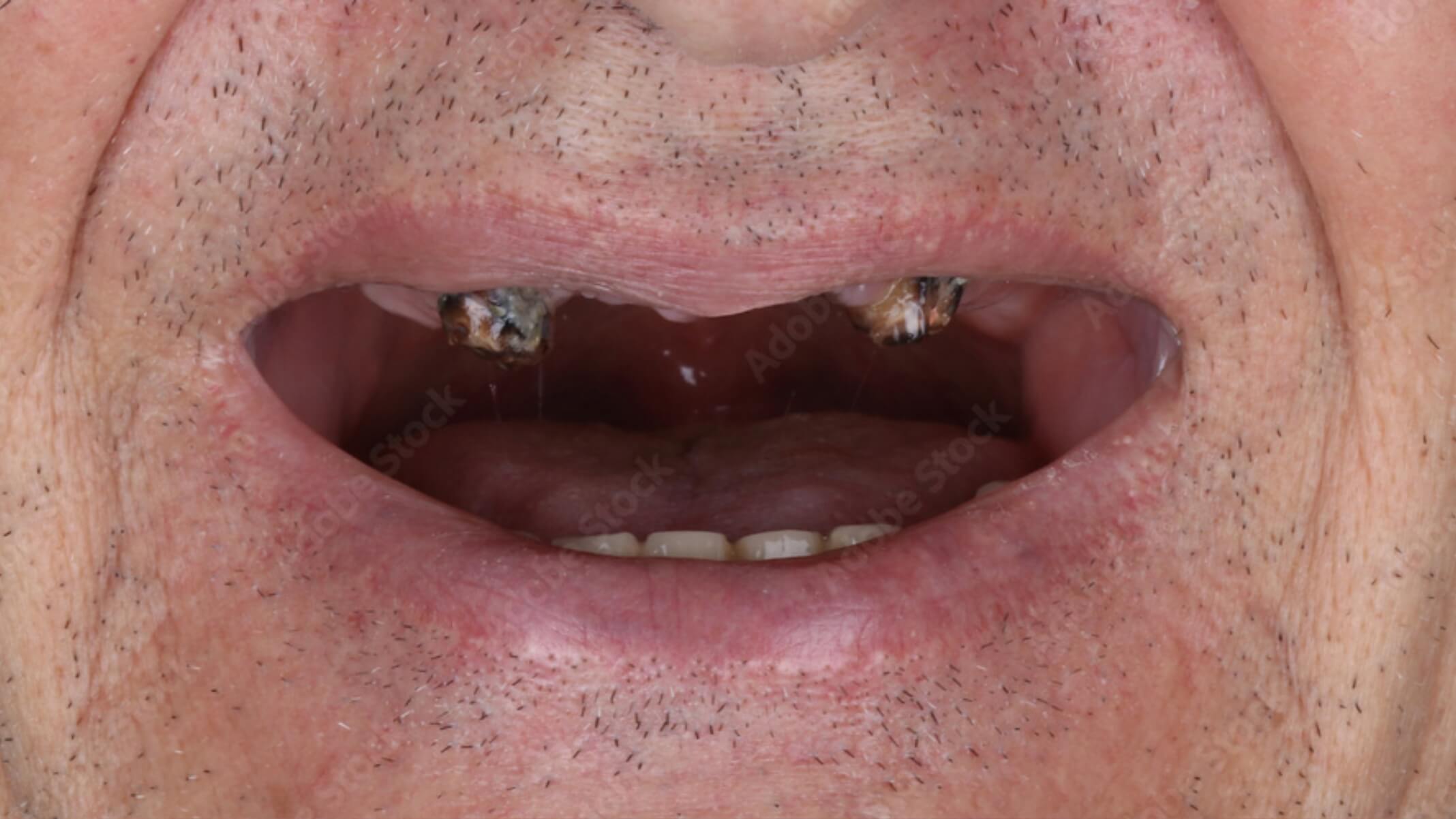 Implante dental antes 3 Implante dental antes 3