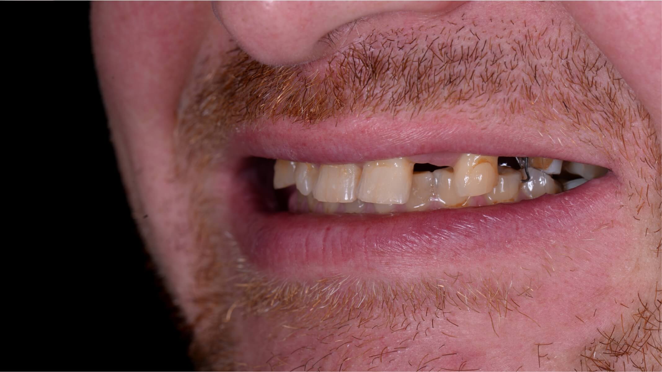 Implante dental antes 1 Implante dental antes 1