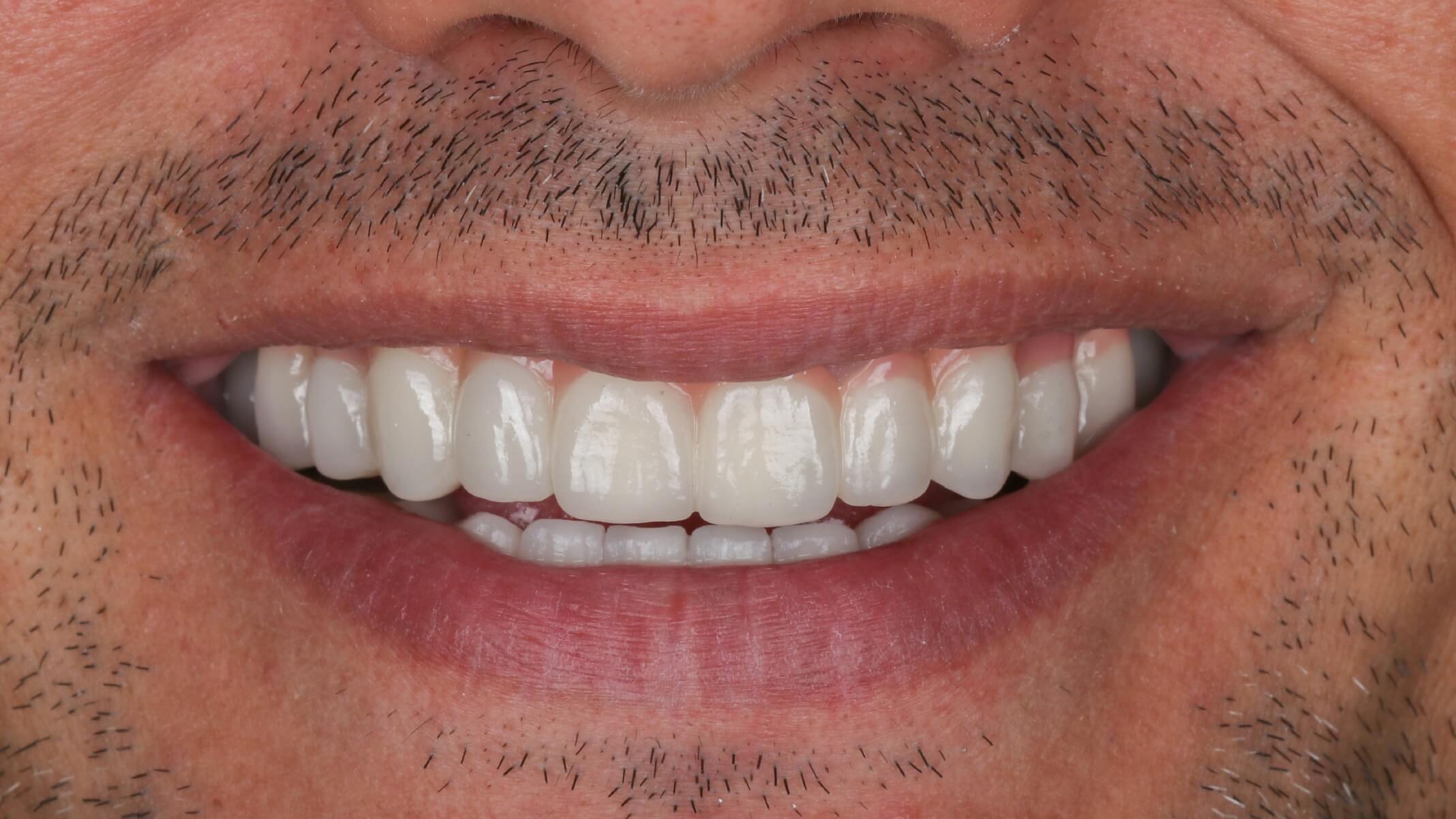 Implante dental después 2 Implante dental después 2