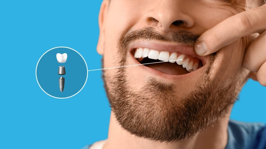 Implantes home FL Dental