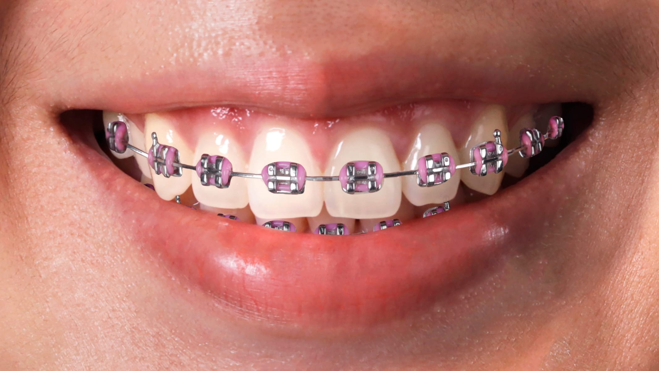 ORTODONCIA INVISIBLE Después 3