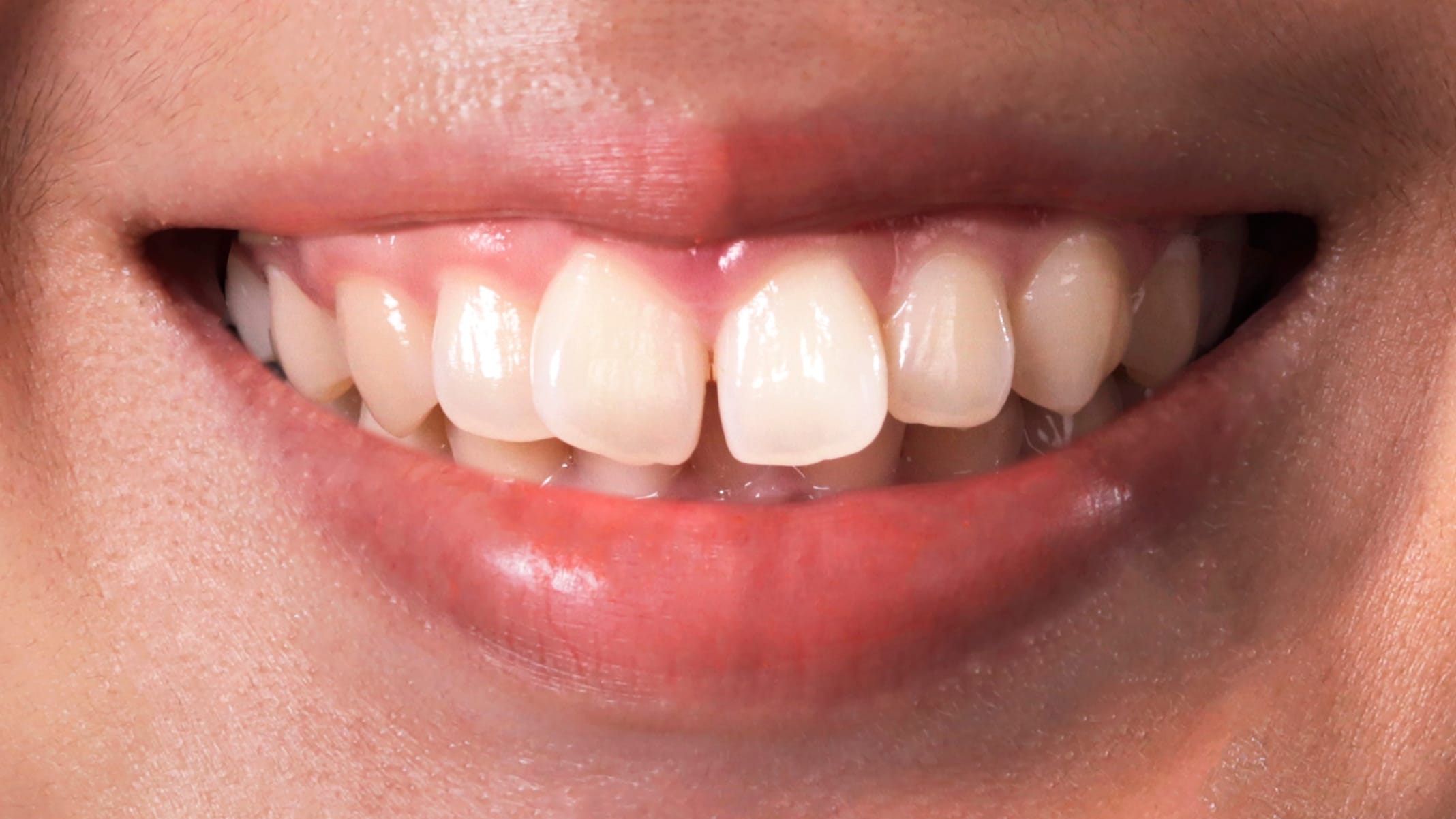 ORTODONCIA INVISIBLE antes 3