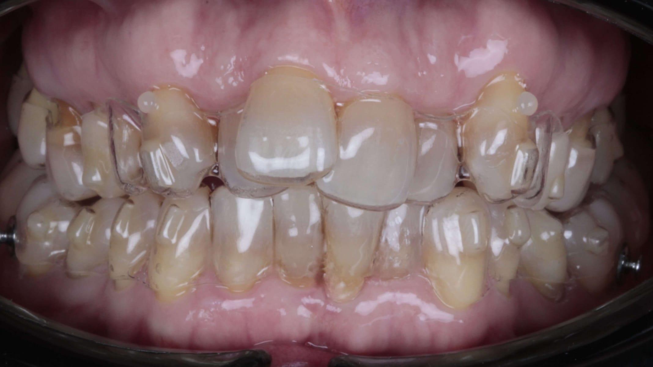 ORTODONCIA INVISIBLE antes 2