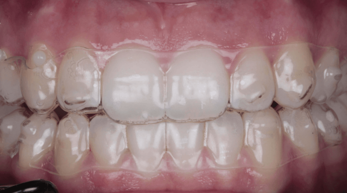 ORTODONCIA INVISIBLE Después 2