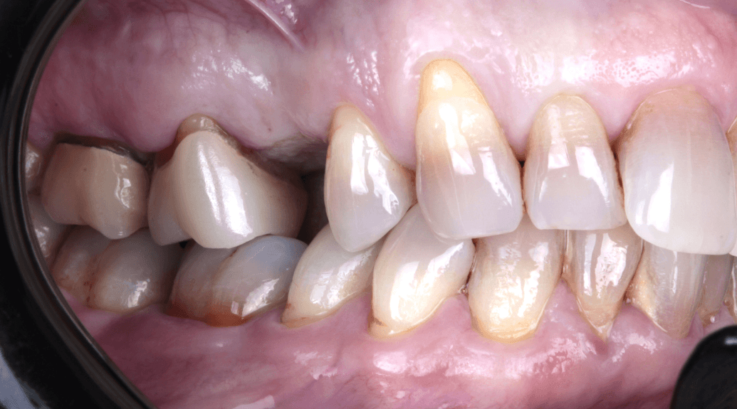 periodoncia antes 3