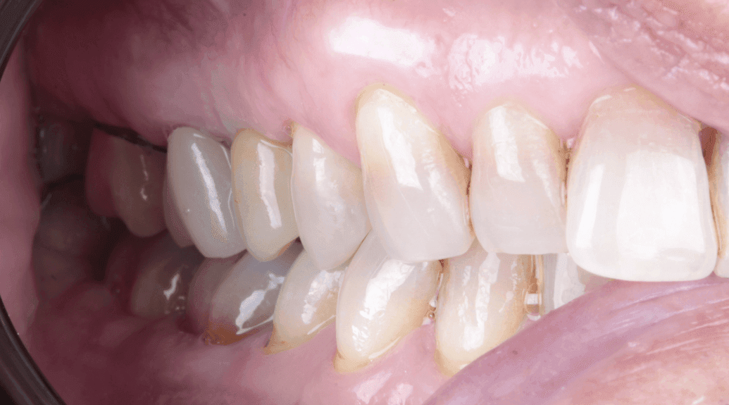 periodoncia después 3