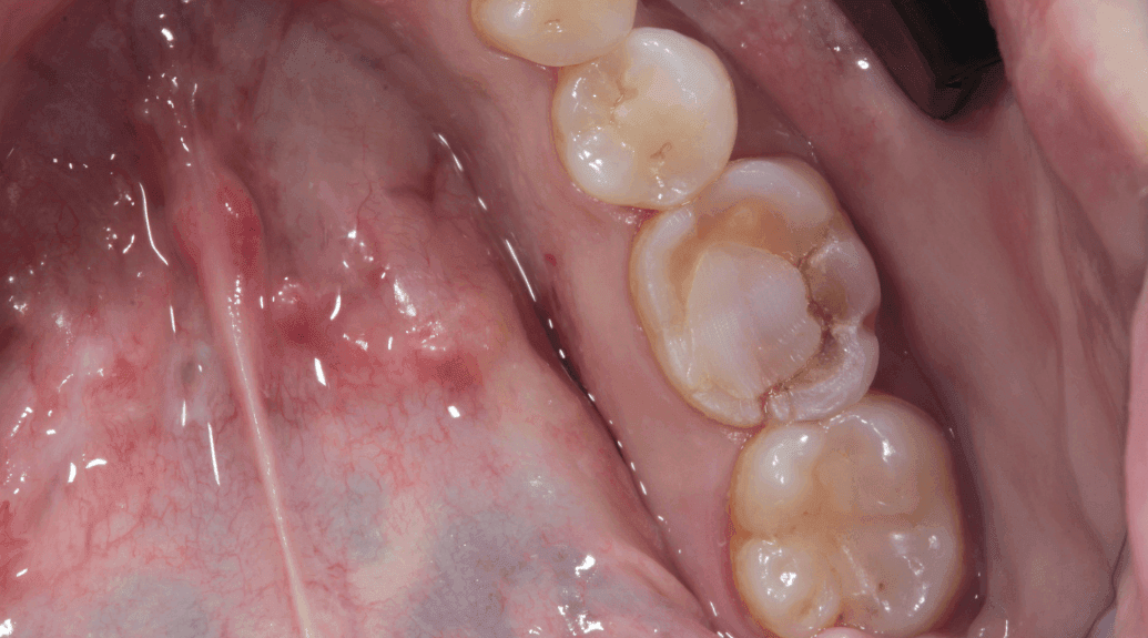 implantes dental antes implantes dental antes