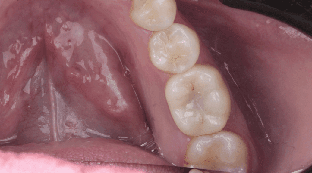 implantes dental después implantes dental después