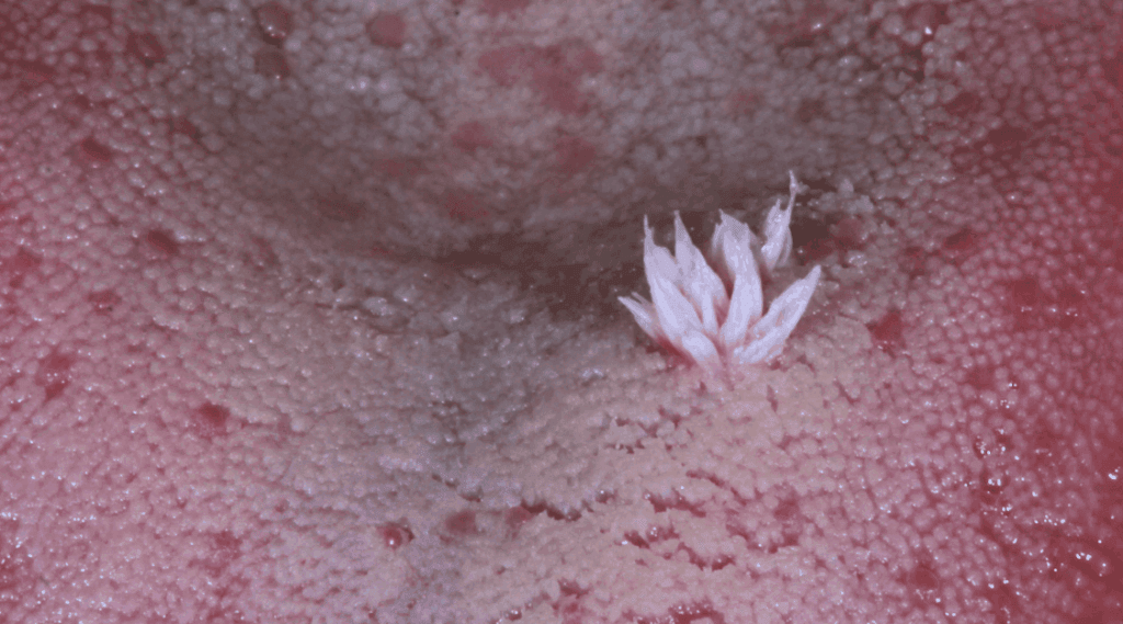 papiloma